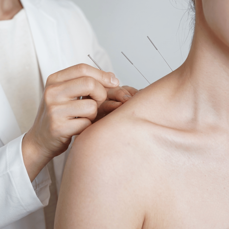 Dry Needling
